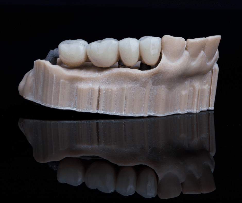 Read More About The Article Dental Bridges: Bridging The Gap To A Confident Smile