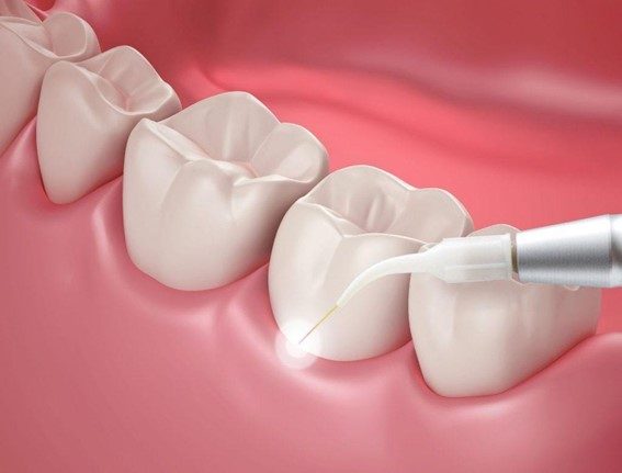 Read More About The Article Laser Dentistry ~ 7 Advantages And Possible Risks