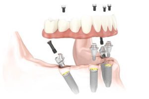 Noble Biocare Dental Implants Read More About The Article Noble Biocare Dental Implants