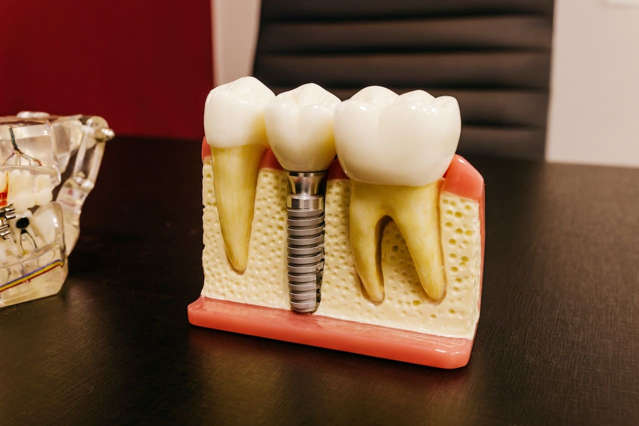 Read More About The Article Post-Operative Diet For Dental Implant Surgery: When Is It Safe To Resume Normal Eating Habits?