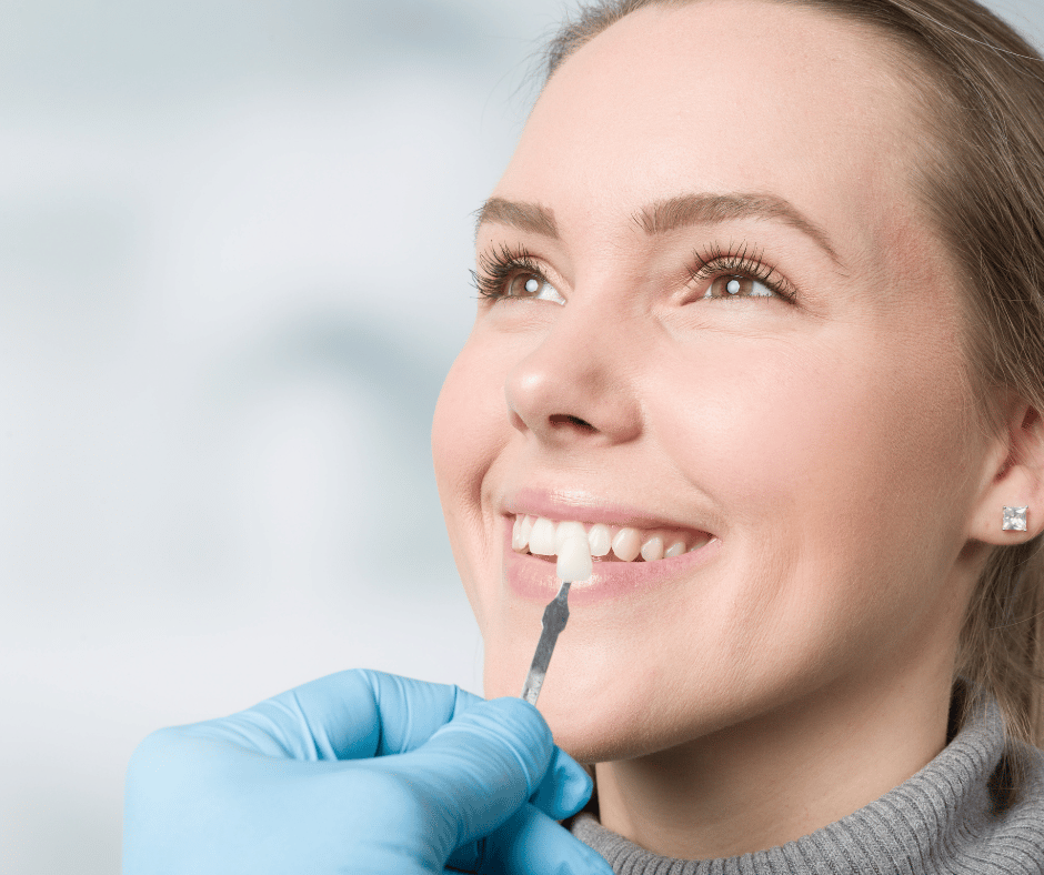 Read More About The Article Do Veneers Cover The Back Of The Tooth?